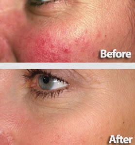 buy metrogel for rosacea