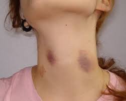 Get Rid of Hickies with these Proven Remedies