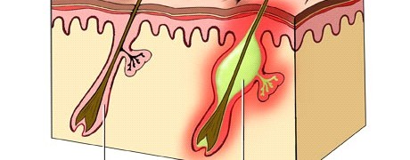 Tips on How to Get Rid of Ingrown Hairs