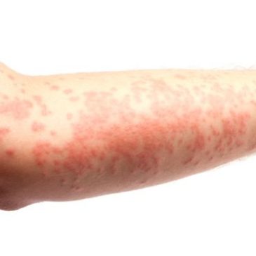 How to Get Rid of Eczema Safely