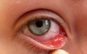 a stye on eye