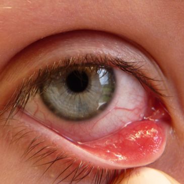 How to Get Rid of a Stye