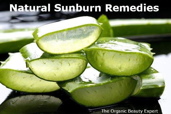 aloe vera sunburn remedy