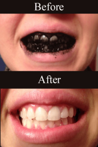 teeth whitening with charcoal