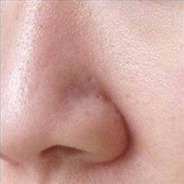 open pores on nose