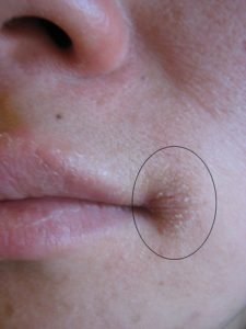 angular cheilitis on mouth