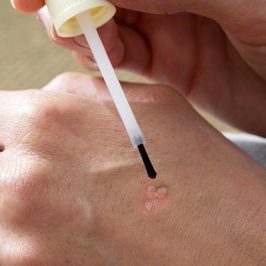 oil to remove warts