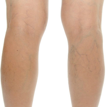 How To Get Rid Of Varicose Veins Using Home Remedies