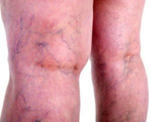 get rid of varicose veins