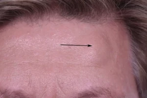forehead osteoma natural treatment