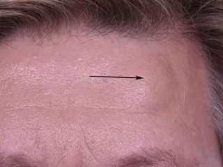 forehead osteoma natural treatment