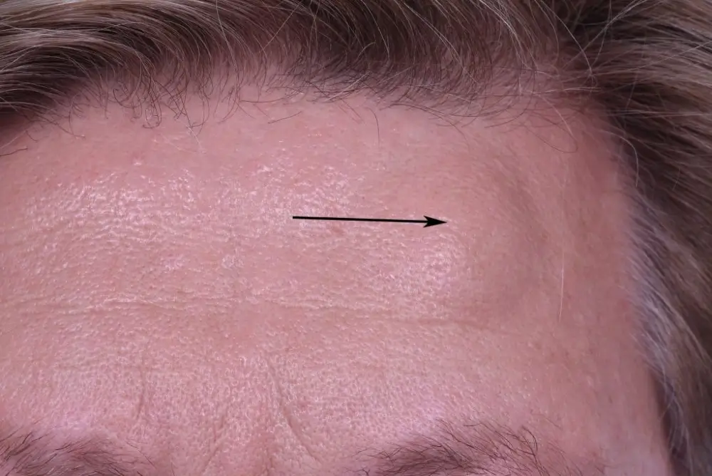 Forehead Osteoma Natural Treatment 5 Effective Remedies